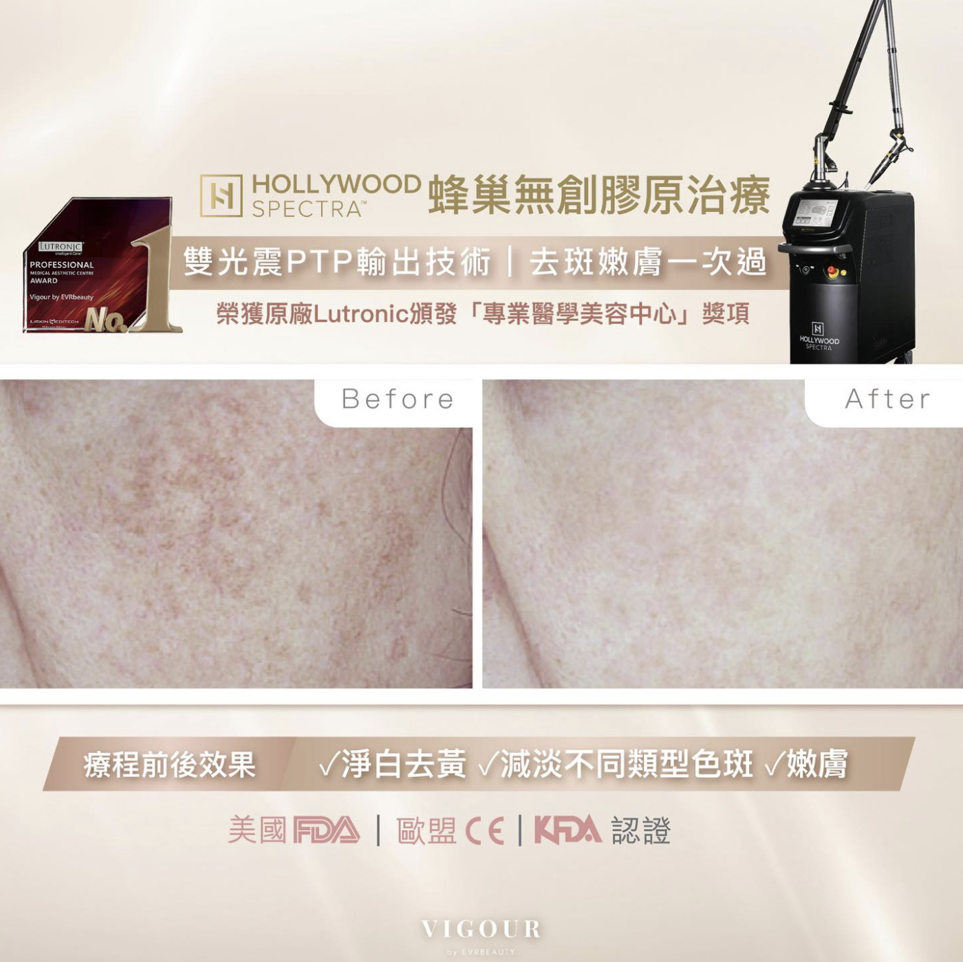 【美白去斑】Hollywood Spectra® 雙光震嫩膚去斑療程