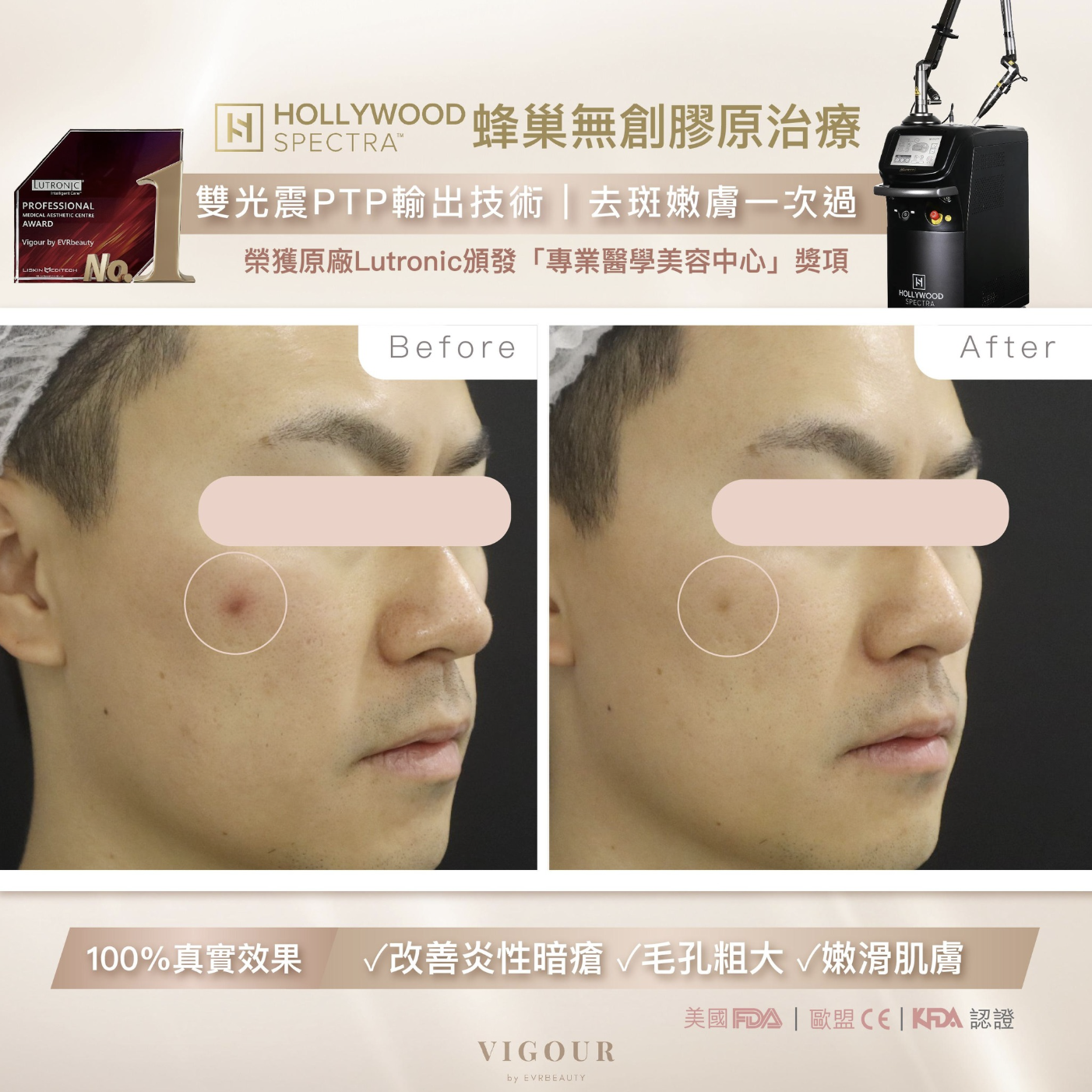 【美白去斑】Hollywood Spectra® 雙光震嫩膚去斑療程