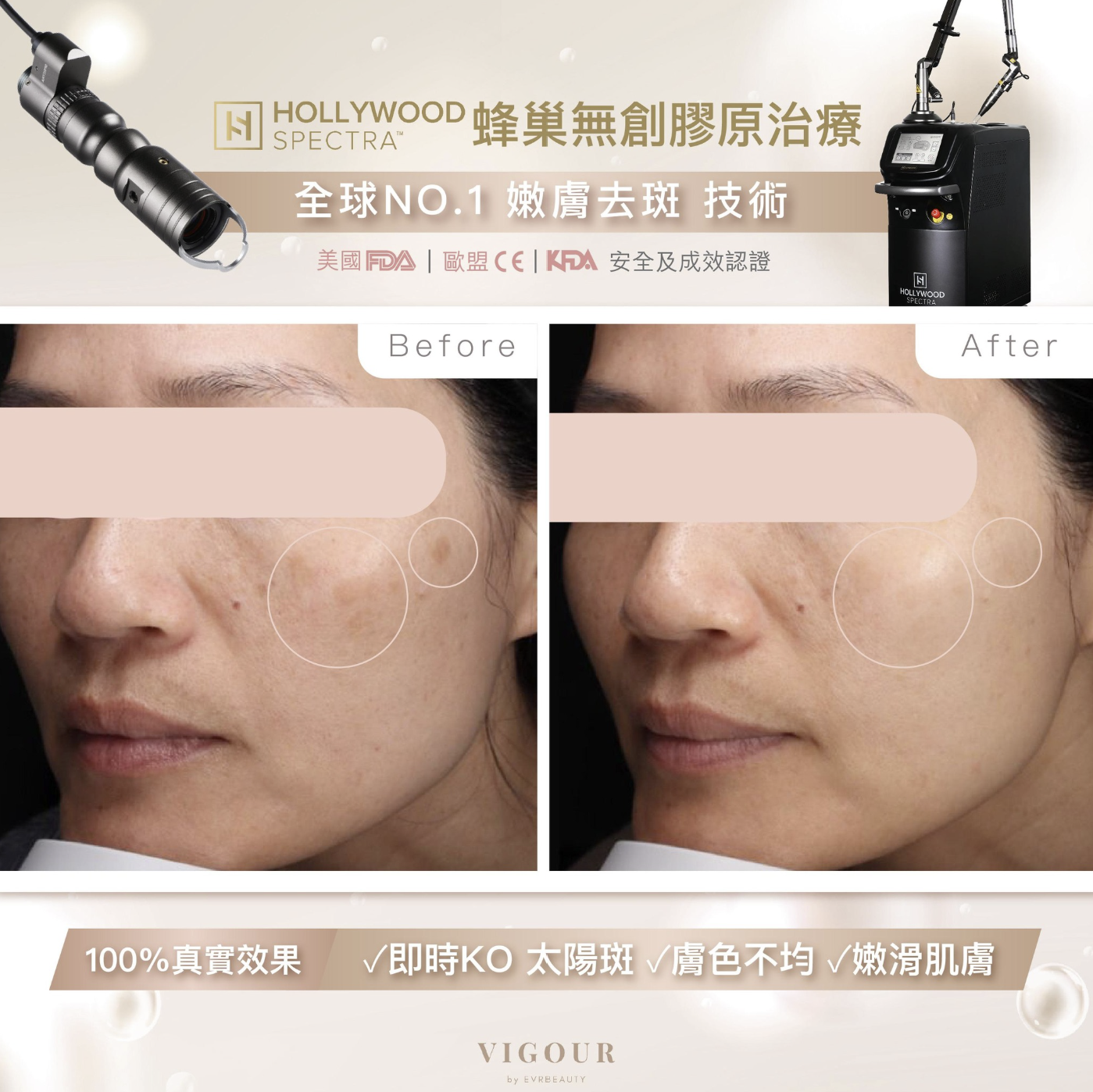 【美白去斑】Hollywood Spectra® 雙光震嫩膚去斑療程