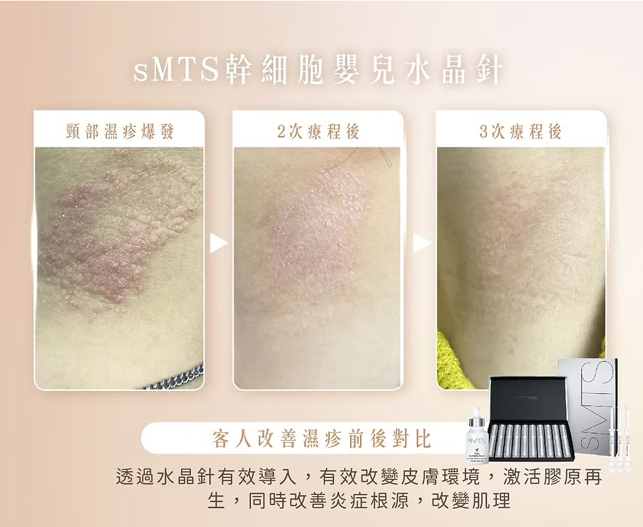 【新客優惠】sMTS 幹細胞嬰兒針療程