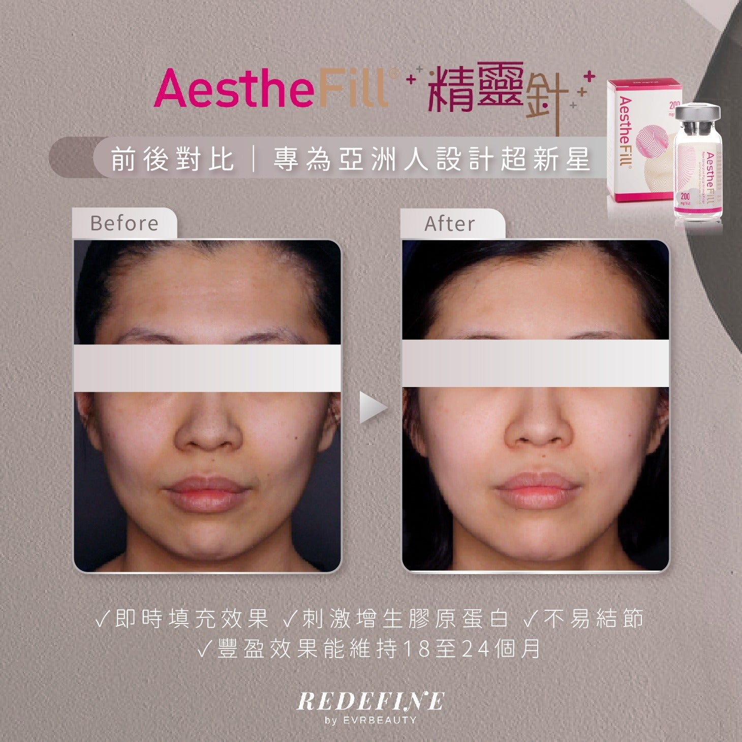 【網購優惠】AestheFill®精靈針47折優惠 - 4針