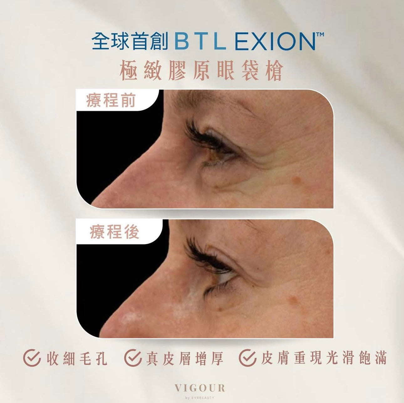 【新客限定】BTL Exion®膠原眼袋槍 緊緻明眸療程