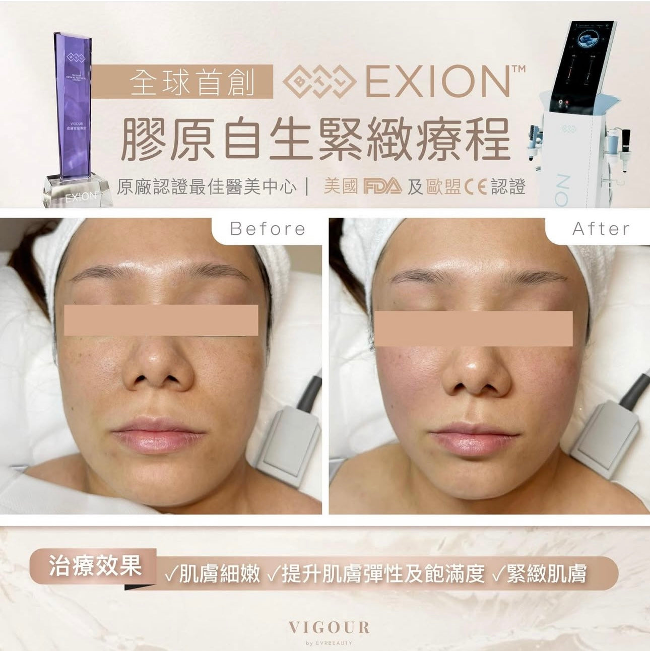 【新客優惠】BTL Exion®膠原自生緊緻療程