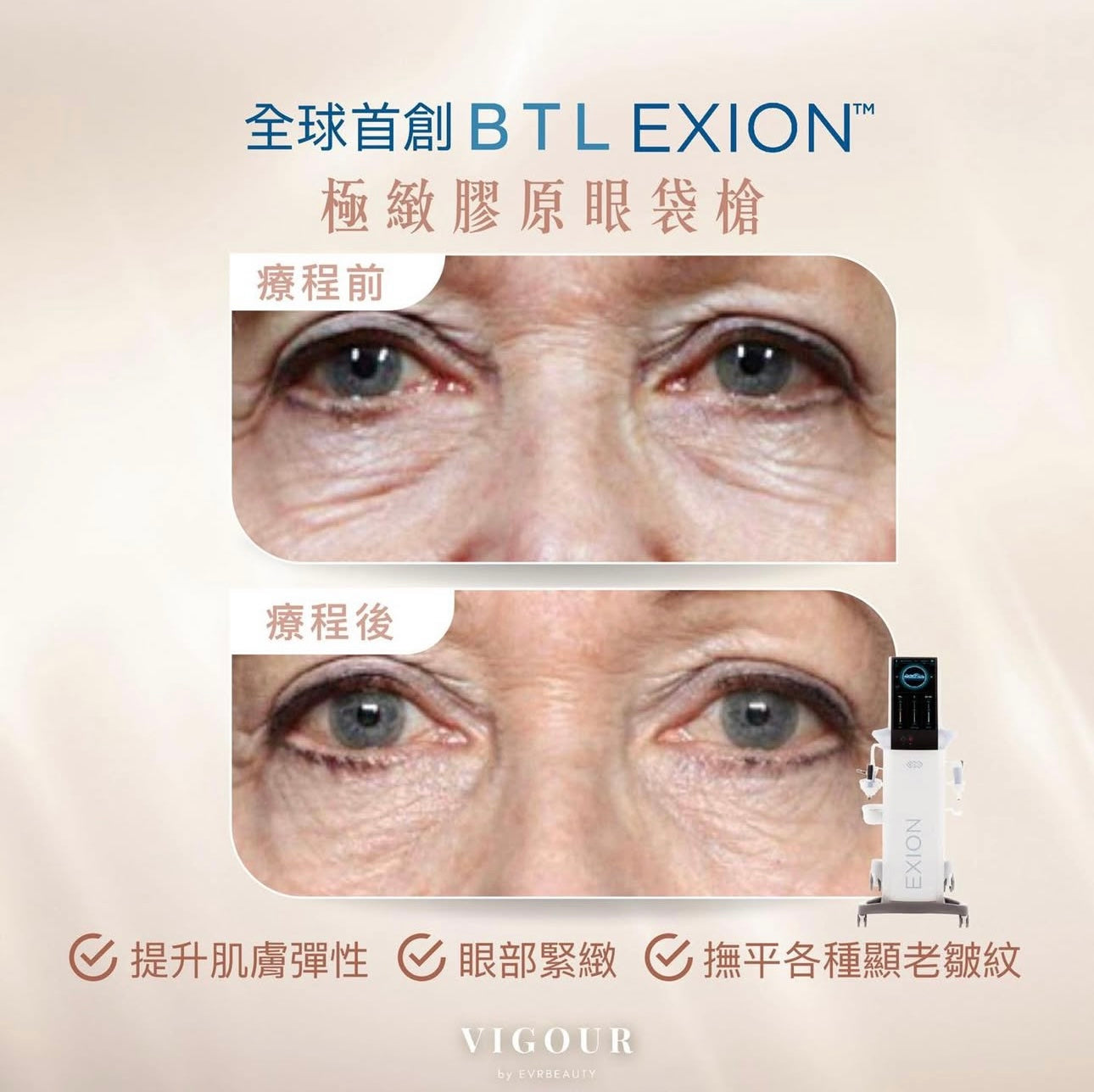 【新客限定】BTL Exion®膠原眼袋槍 緊緻明眸療程