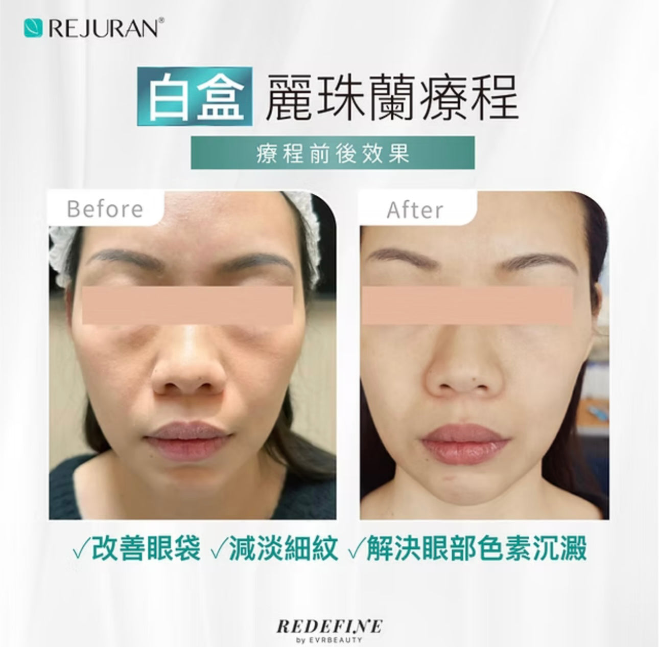 【新客限定】REJURAN 麗珠蘭(白盒)水光針