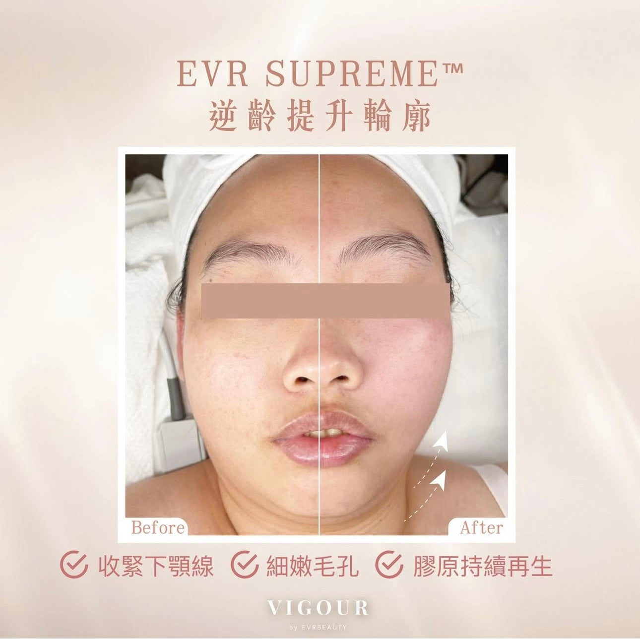 【獨家尊享】SUPREME 逆齡提升輪廓療程