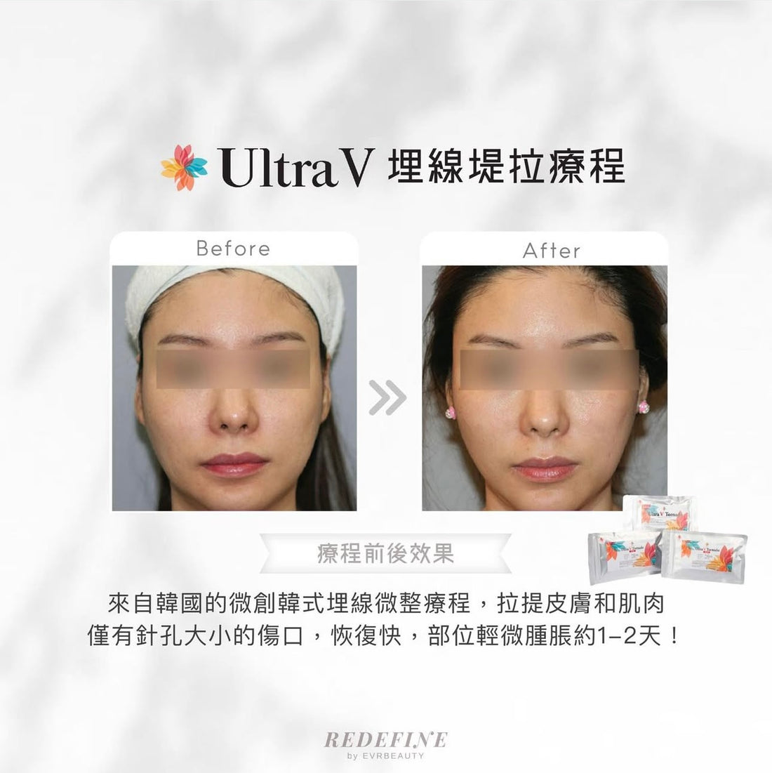 【New Customers Only】Thread Lifting® Medical Thread Embedding Treatment 6 Threads