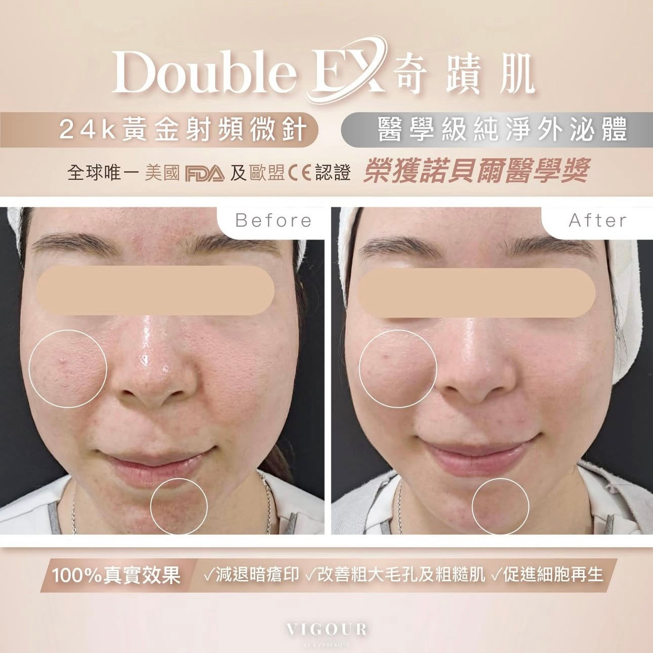 【獨家尊享】DOUBLE EX 奇蹟肌幹細胞修復療程