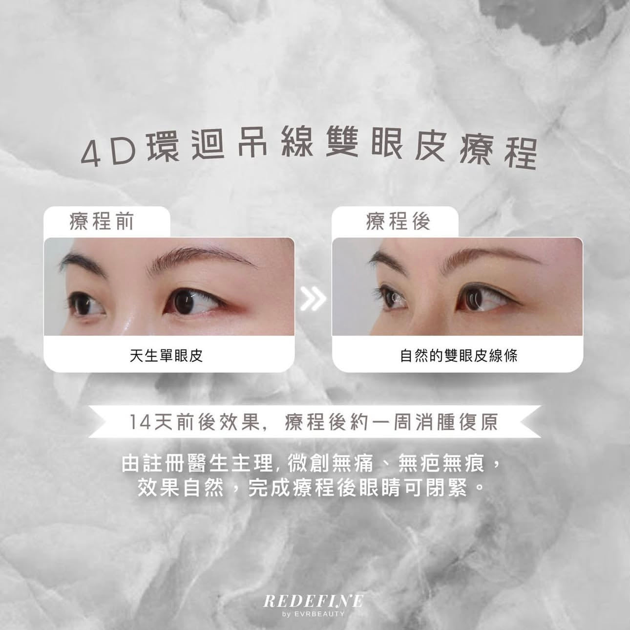 【全港獨家】4D環迴8點式吊線雙眼皮