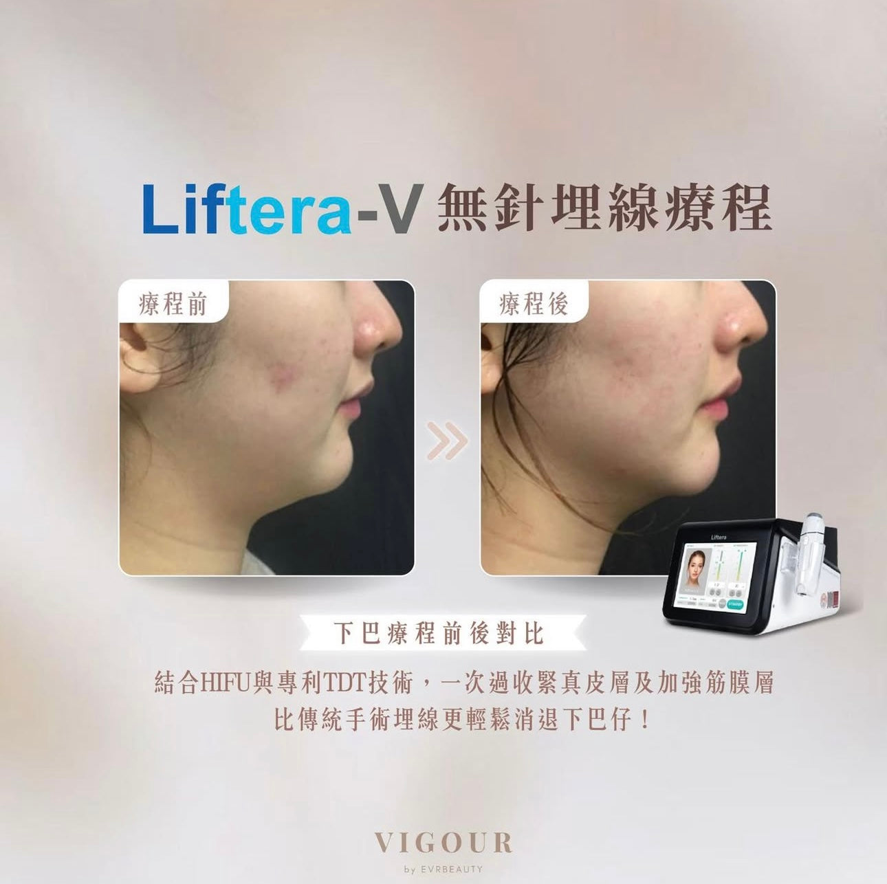 【最強HIFU】LIFTERA-V® 專業無針埋線療程