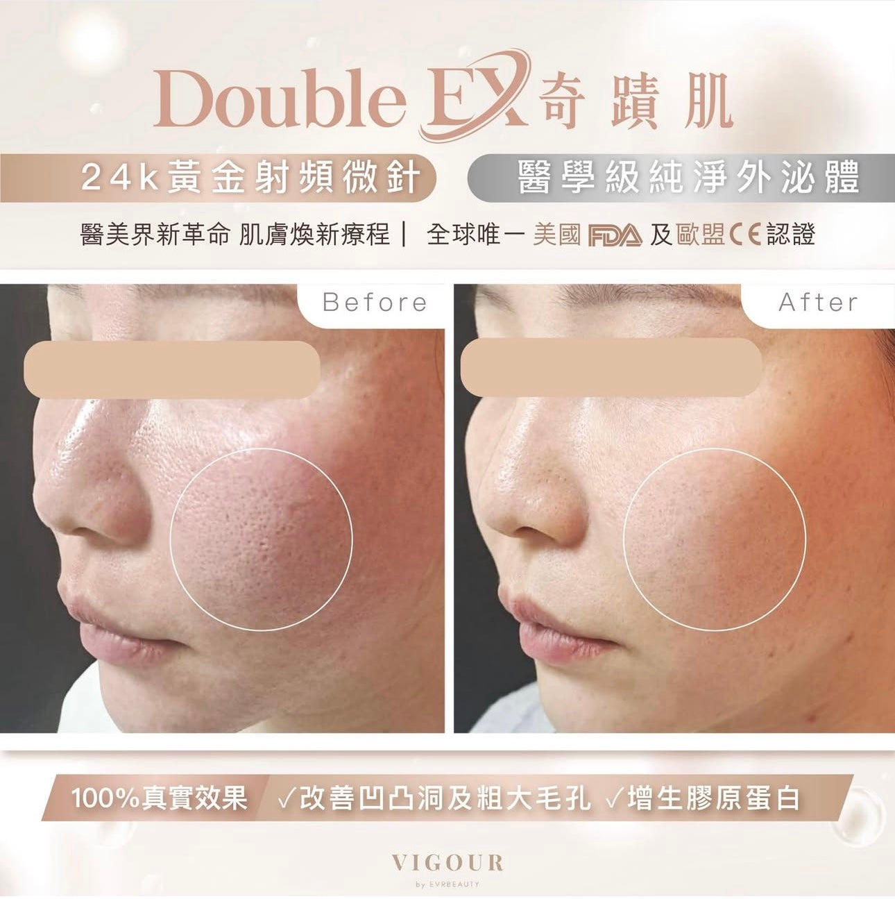 【獨家尊享】DOUBLE EX 奇蹟肌幹細胞修復療程