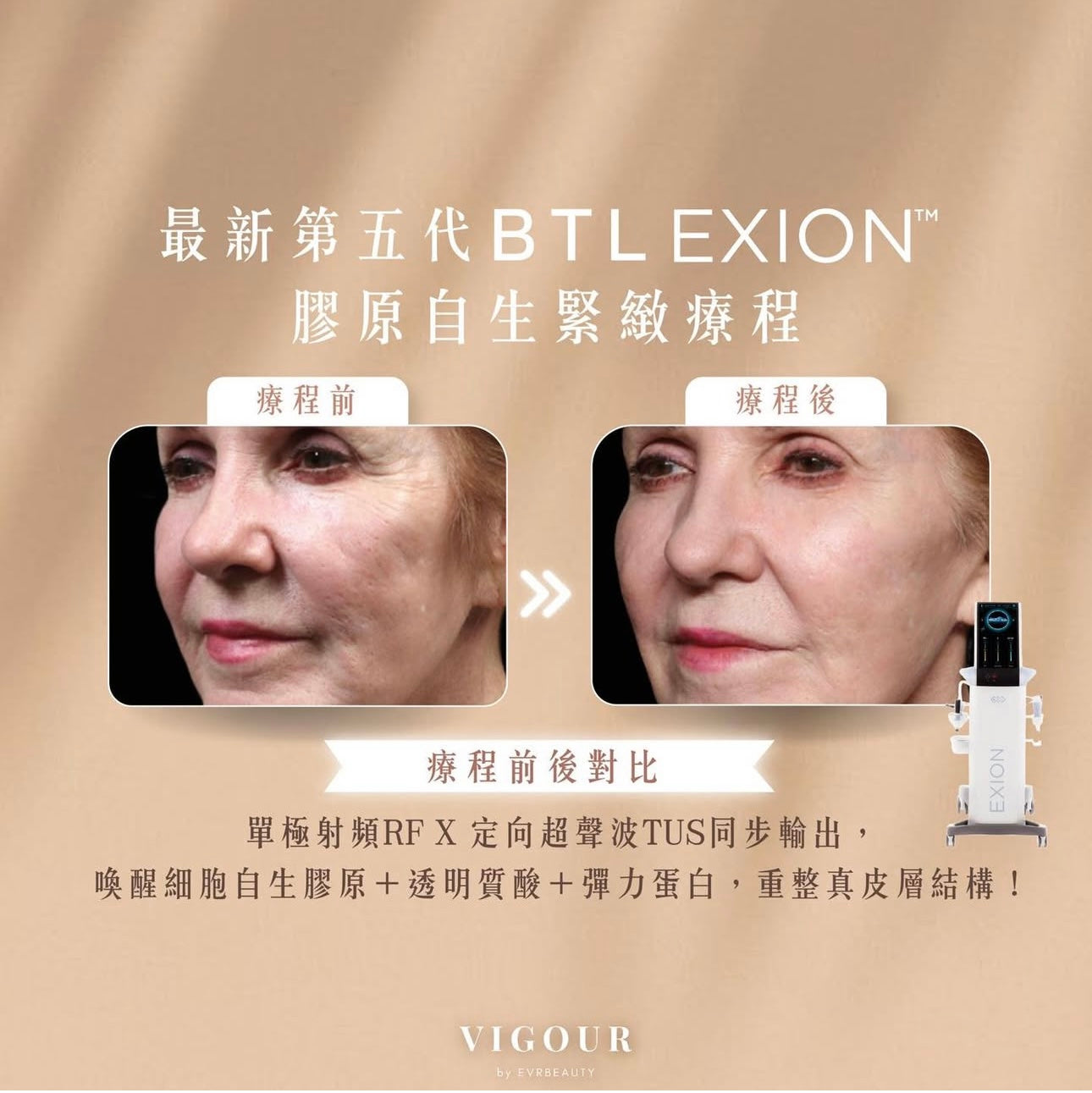 【新客優惠】BTL Exion®膠原自生緊緻療程