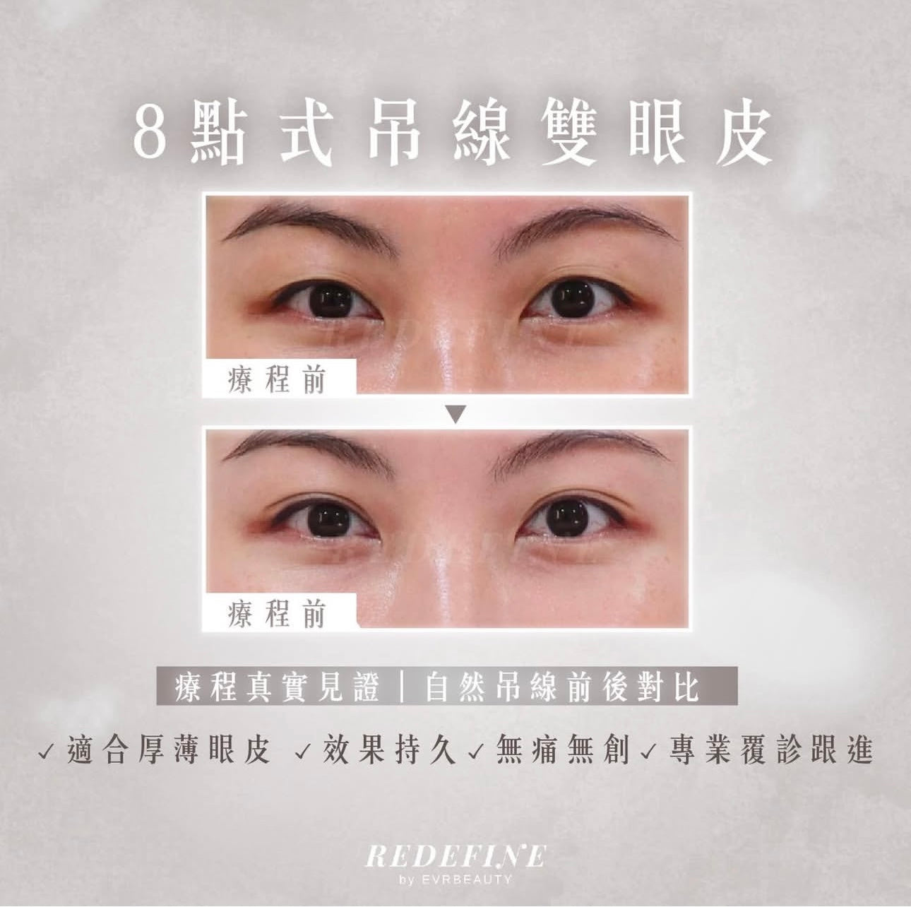 【全港獨家】4D環迴8點式吊線雙眼皮