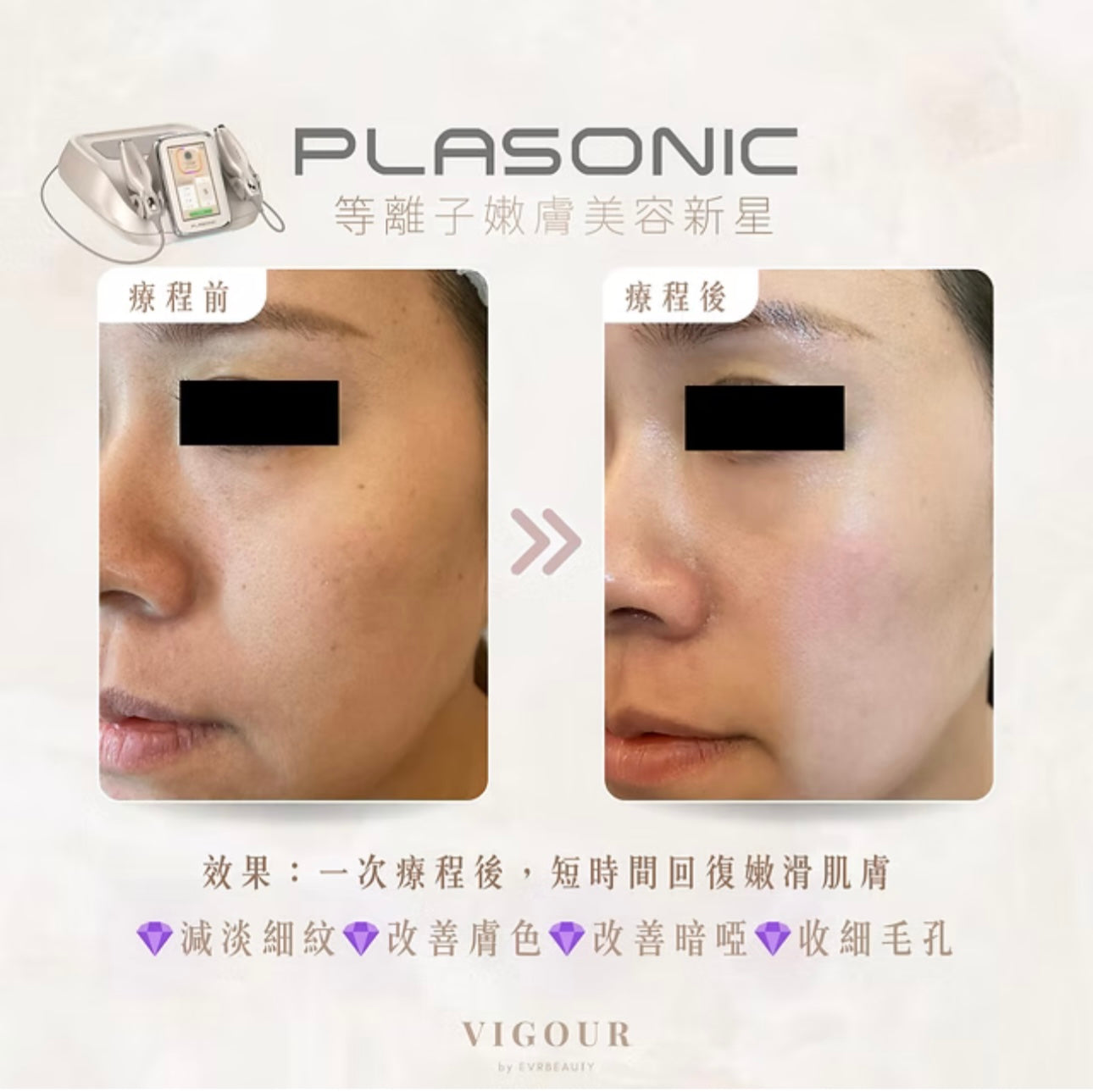 【新客優惠】PLASONIC等離子細胞修護逆齡儀嫩膚療程