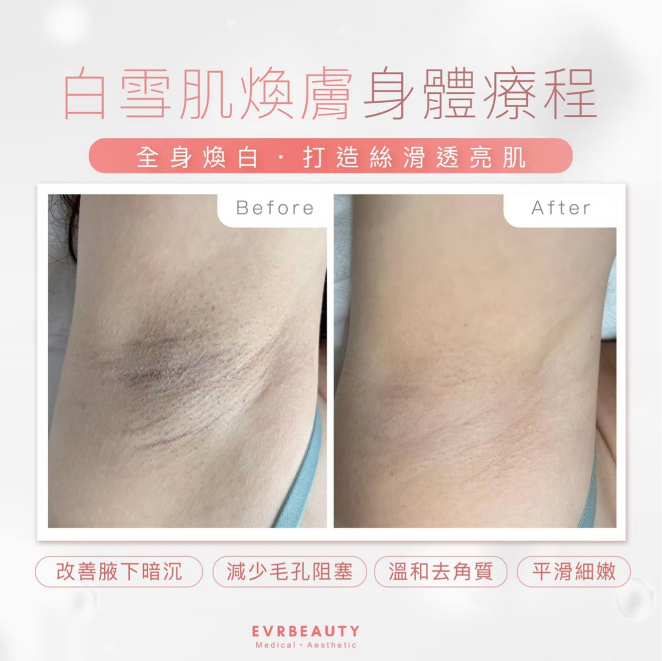 醫學級白雪肌煥膚身體療程 單次/10次/20次