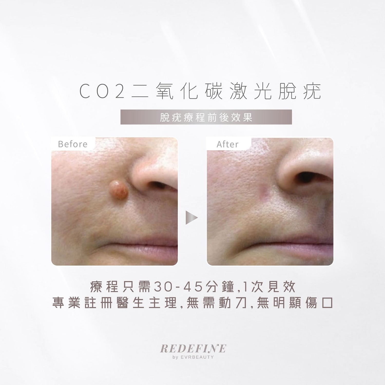 【新客限定】激光脫疣療程(可CLAIM保險)