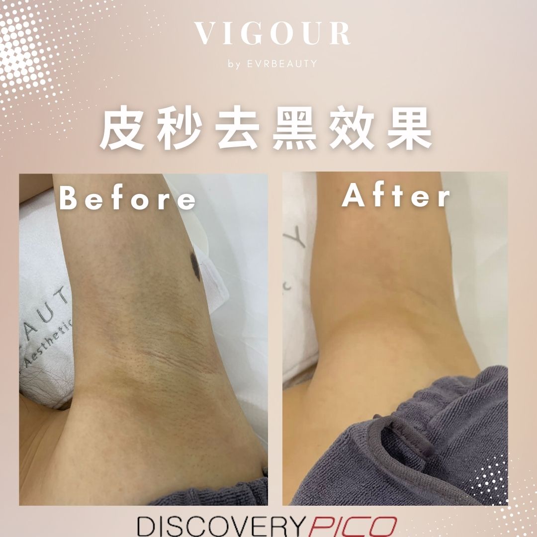 【皮秒去黑】Pico 1064nm 皮秒腋下美白嫰膚 6/12/18次