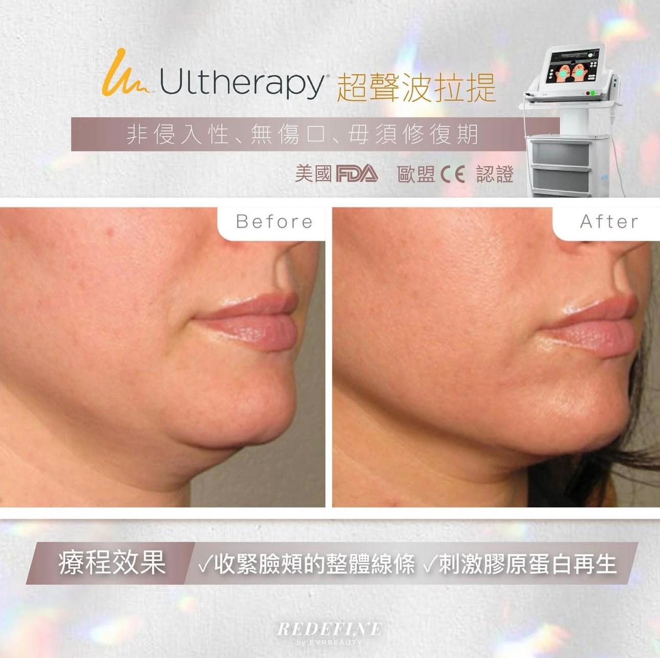【獨家尊享】美國ULTHERAPY® 超聲刀緊緻提拉療程