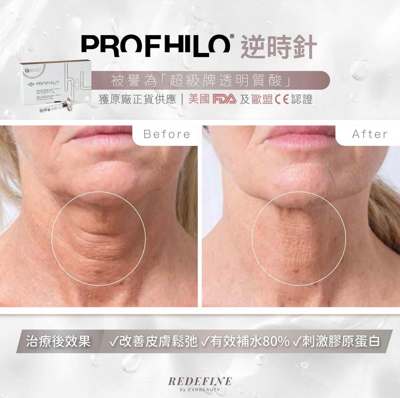 【新客限定】PROFHILO®逆時針 2ml