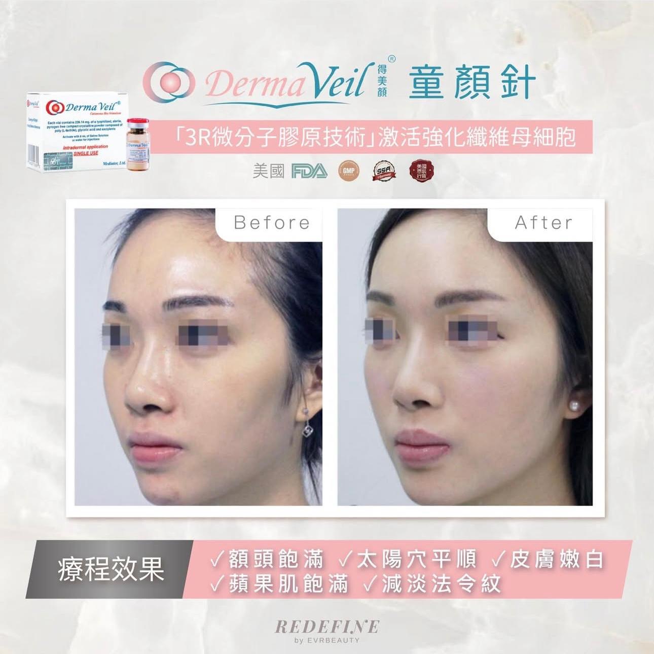 【新客限定】DERMA VEIL® 第二代童顏針療程 1瓶