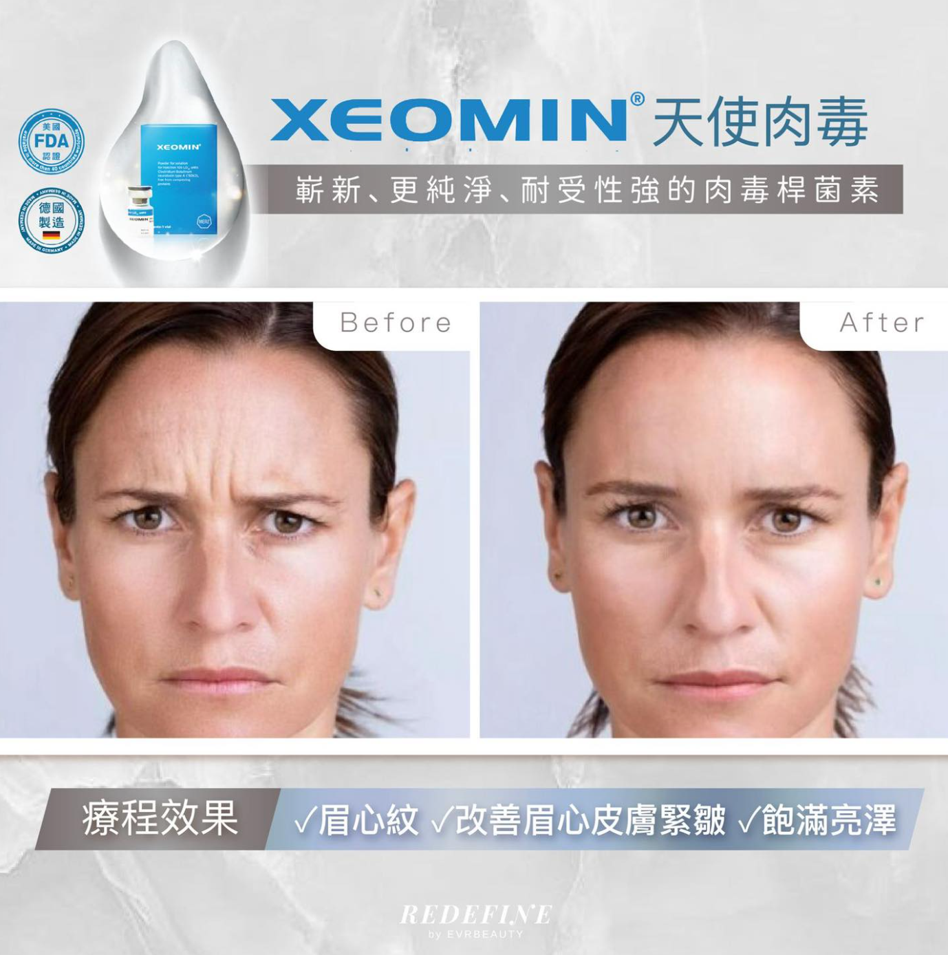 【新客限定】XEOMIN® 肉毒桿菌素