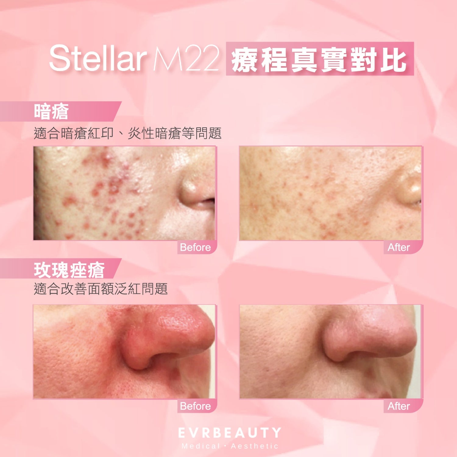 【新客優惠】醫療版Stellar M22 超脈衝激光