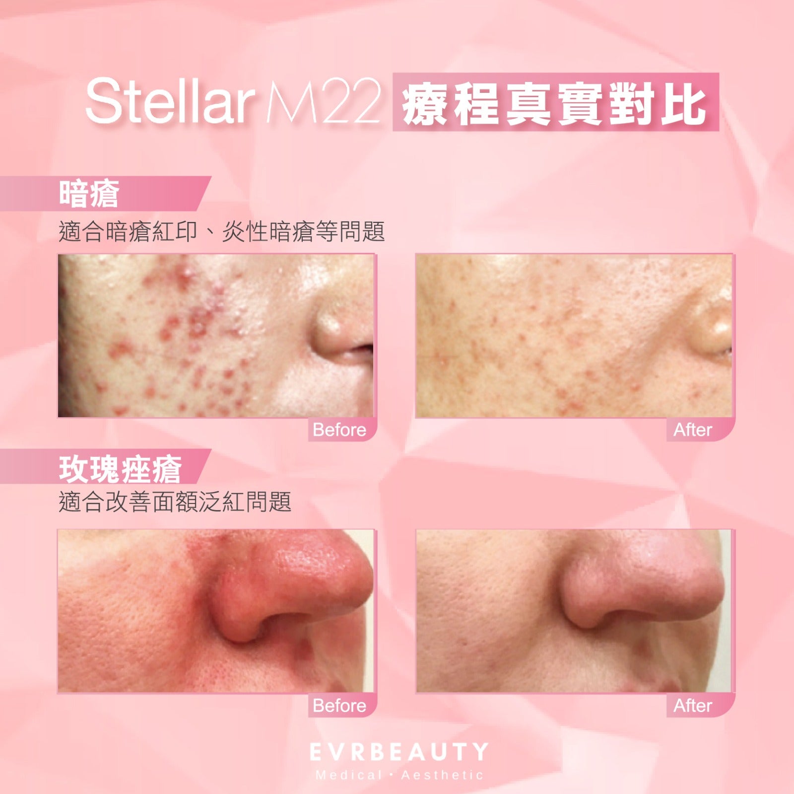 【新客優惠】醫療版Stellar M22 超脈衝激光