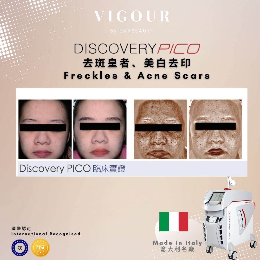 【新客限定】PICO DUAL皮秒蜂巢去除凹凸洞療程