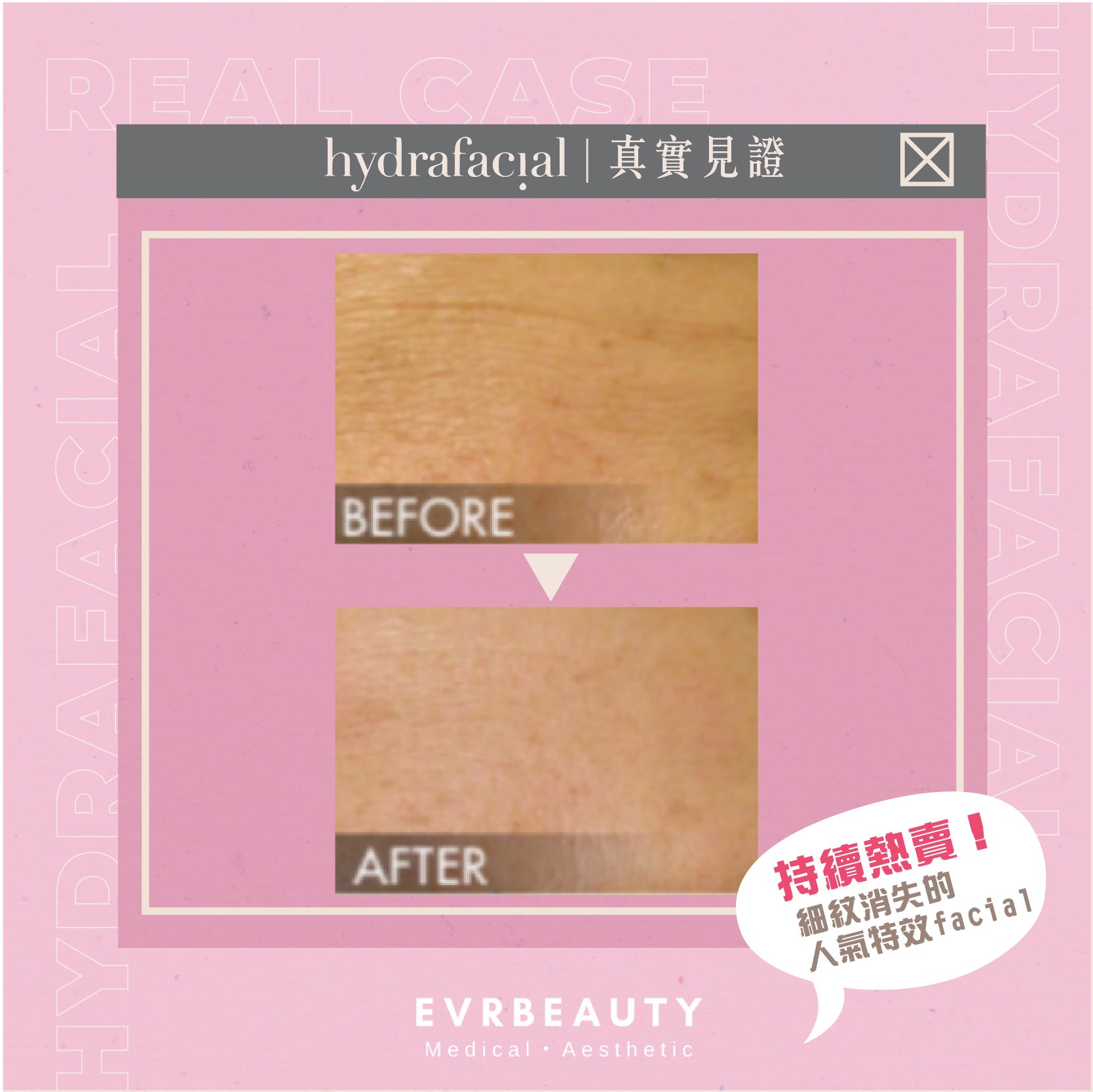 【新客優惠】Hydrafacial 毛孔DETOX暗瘡隱身肌
