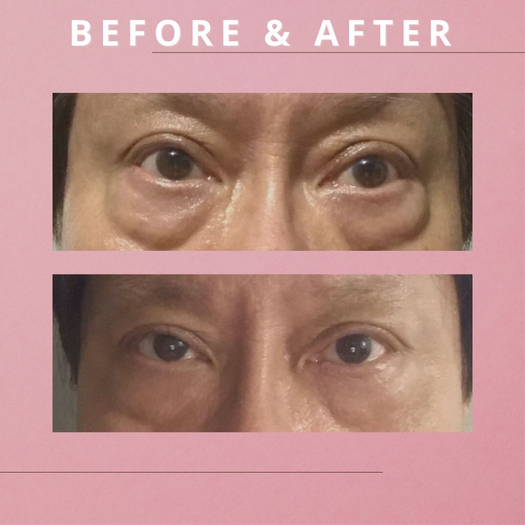【新客限定】EXILIS ULTRA 360™ 升級膠原眼袋槍