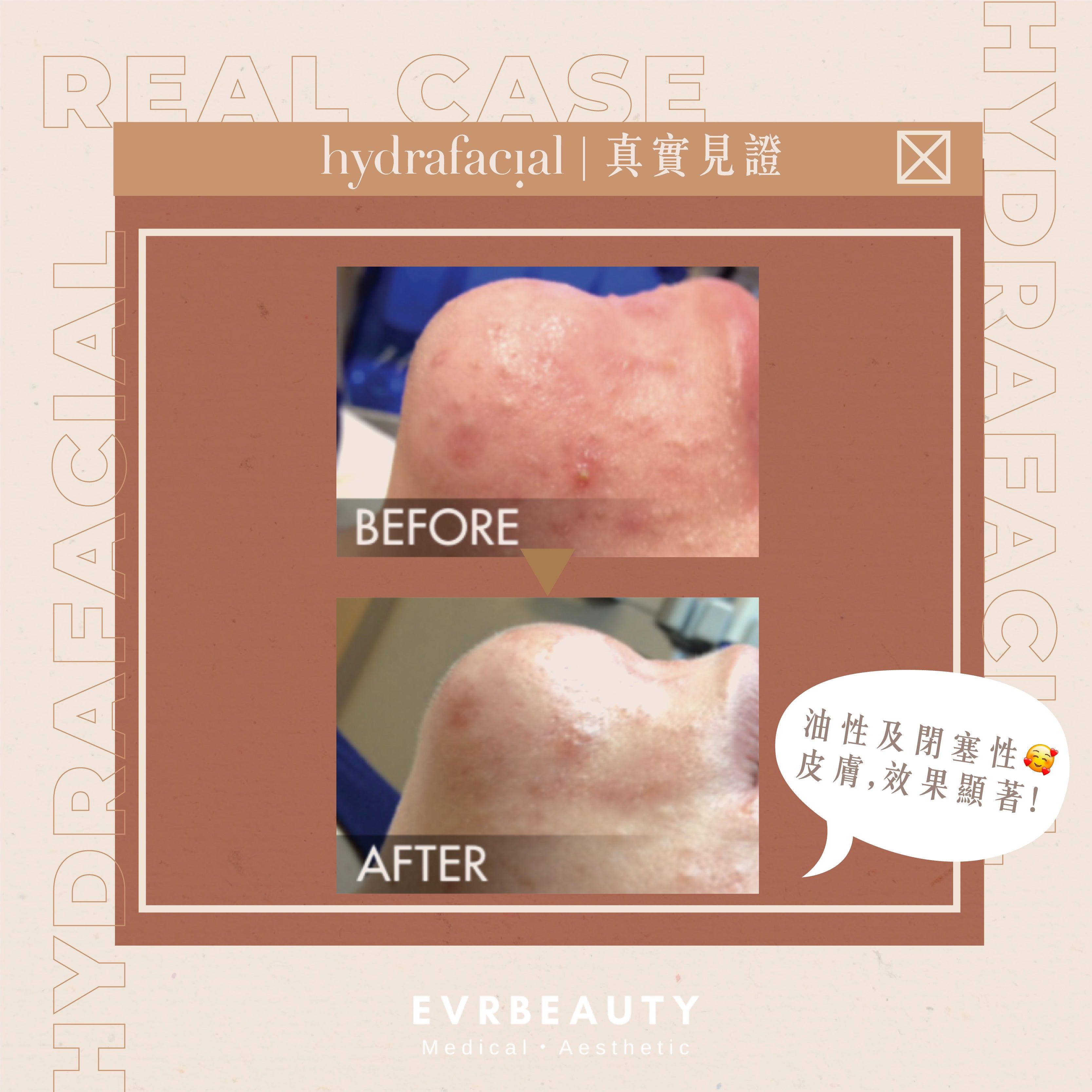 【新客優惠】Hydrafacial 毛孔DETOX暗瘡隱身肌