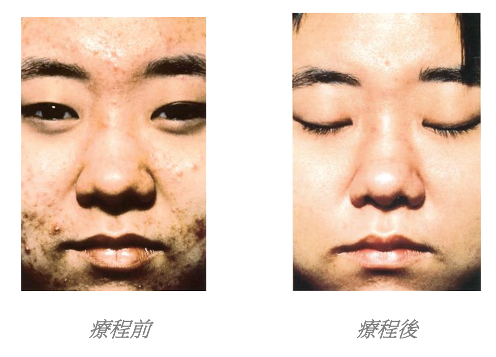 Skin Peel fruit acid peeling single / 10 times / 20 times