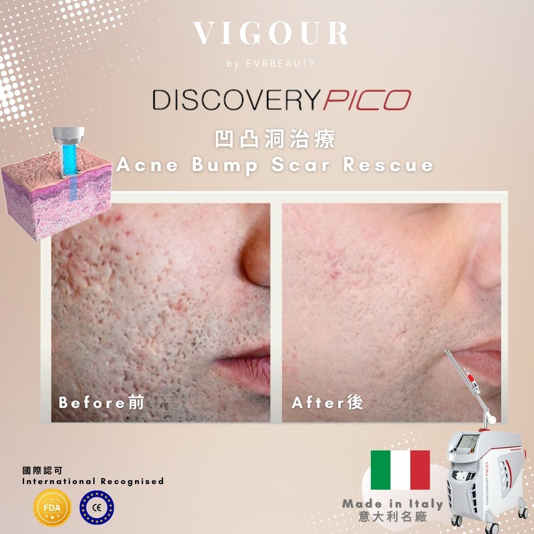 【美白去斑】PICO 1064nm 皮秒美白去斑激光 新客首次優惠