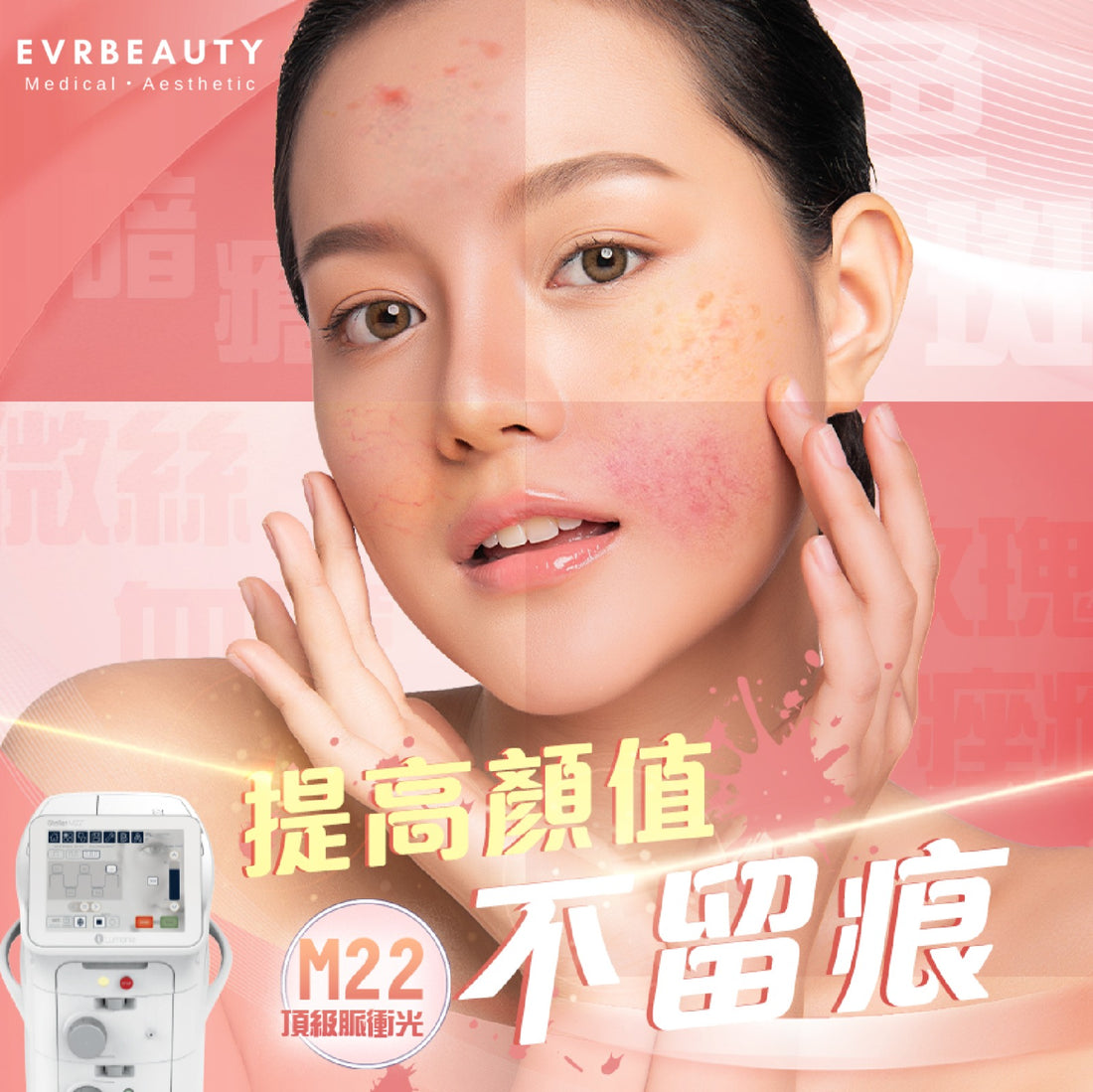 【新客優惠】醫療版Stellar M22 超脈衝激光