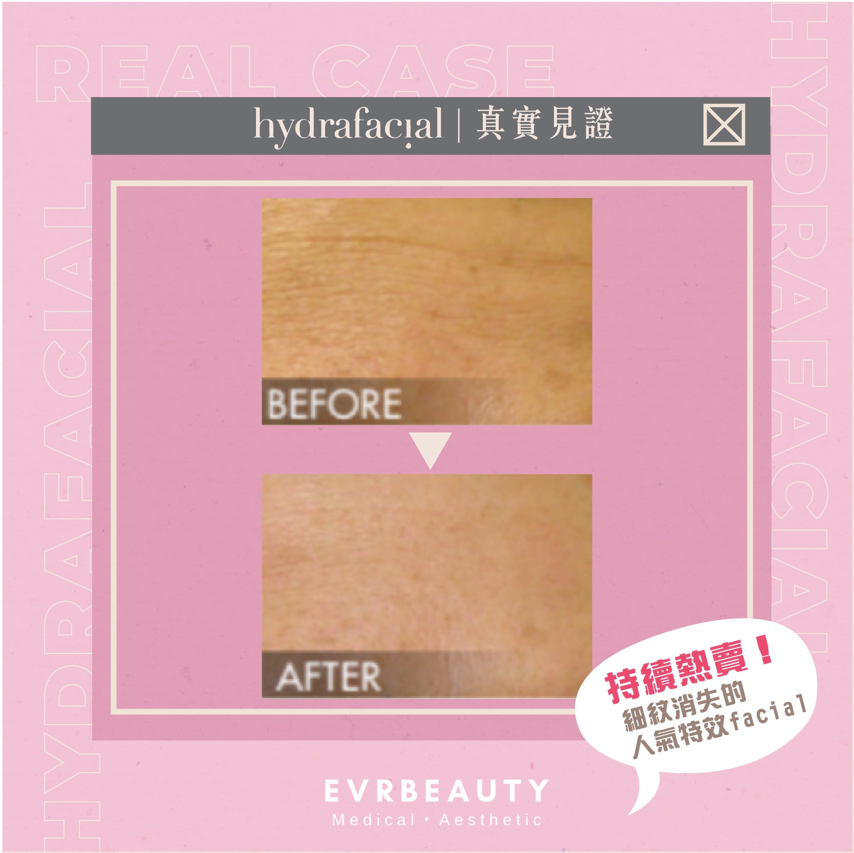 【New Customer Offer】Skin Refiner HydraFacial