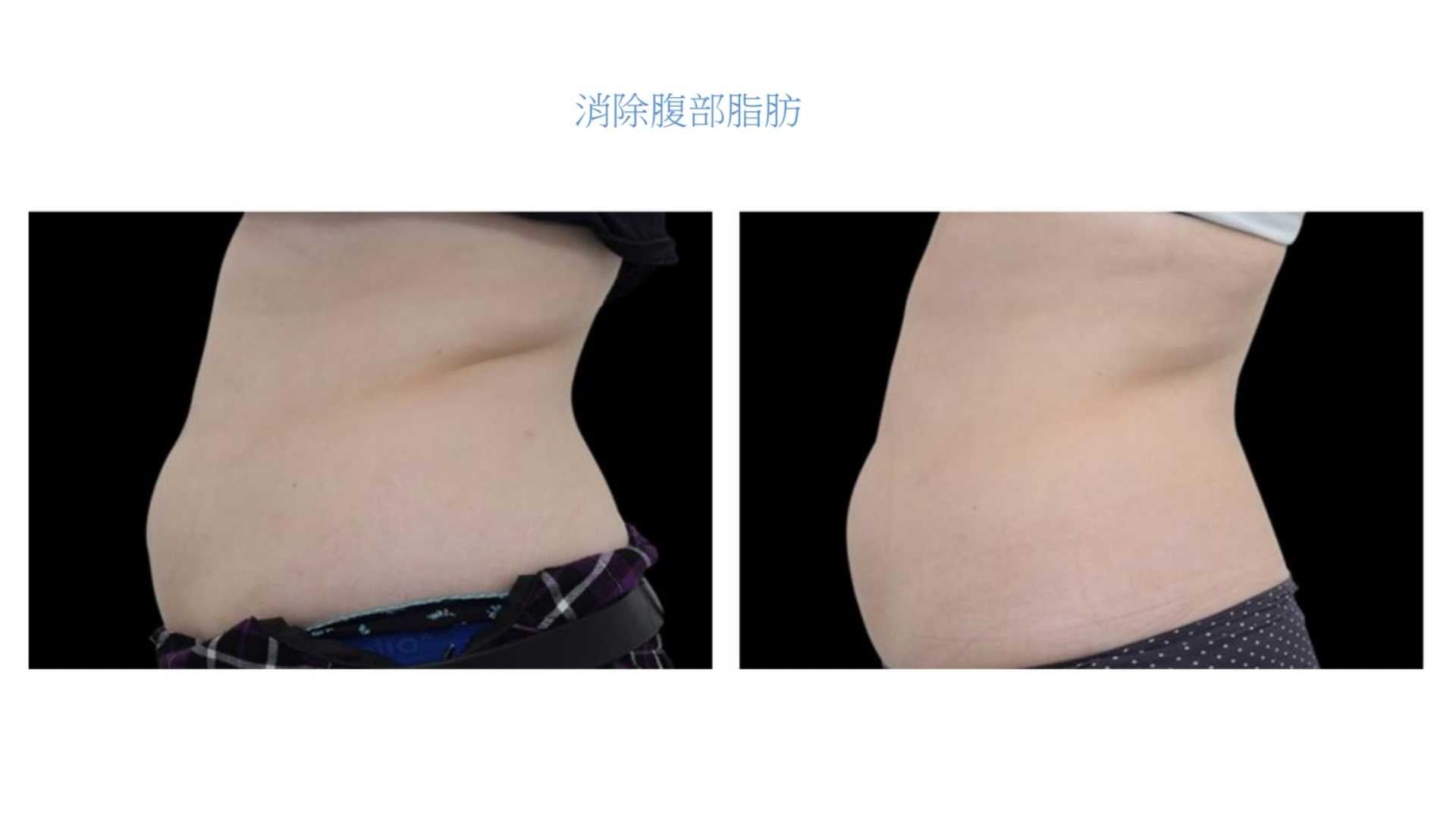 【新客限定】EXILIS 360™ 深層定位消脂