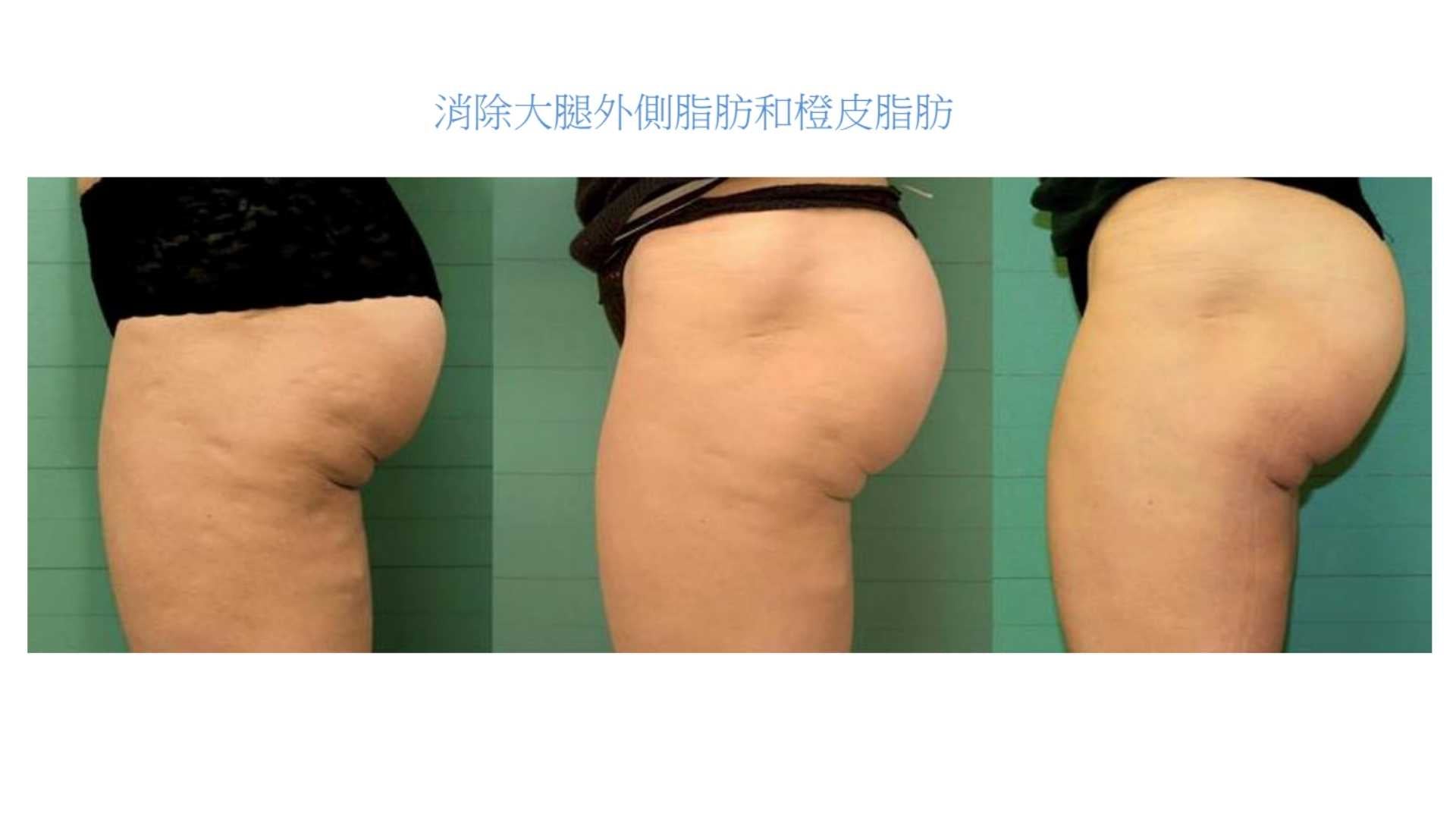 【New Customers Only】EXILIS 360™ Deep Targeted Cellulite Reduction