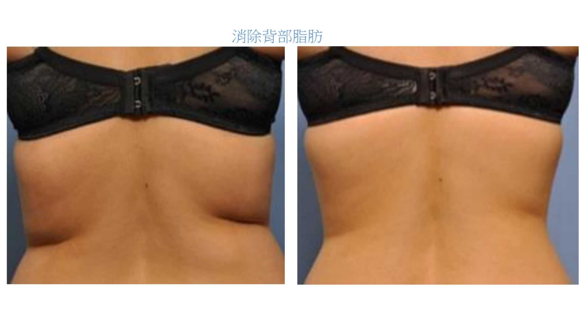 【新客限定】EXILIS 360™ 深層定位消脂