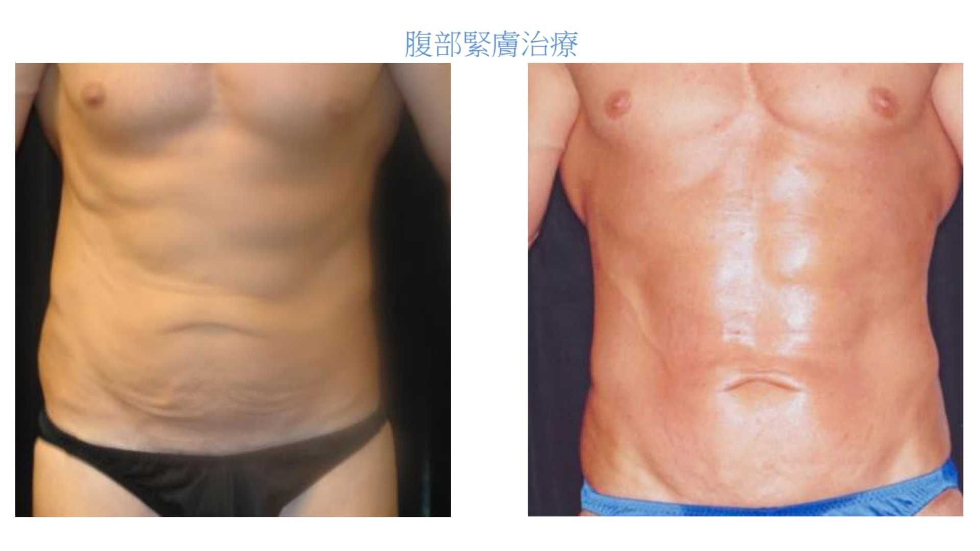 【新客限定】EXILIS 360™ 深層定位消脂