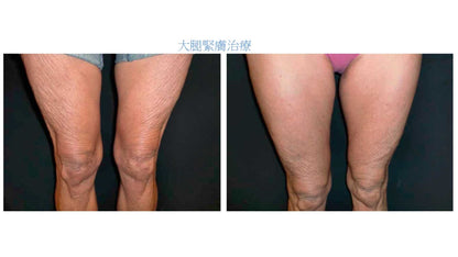 【New Customers Only】EXILIS 360™ Deep Targeted Cellulite Reduction