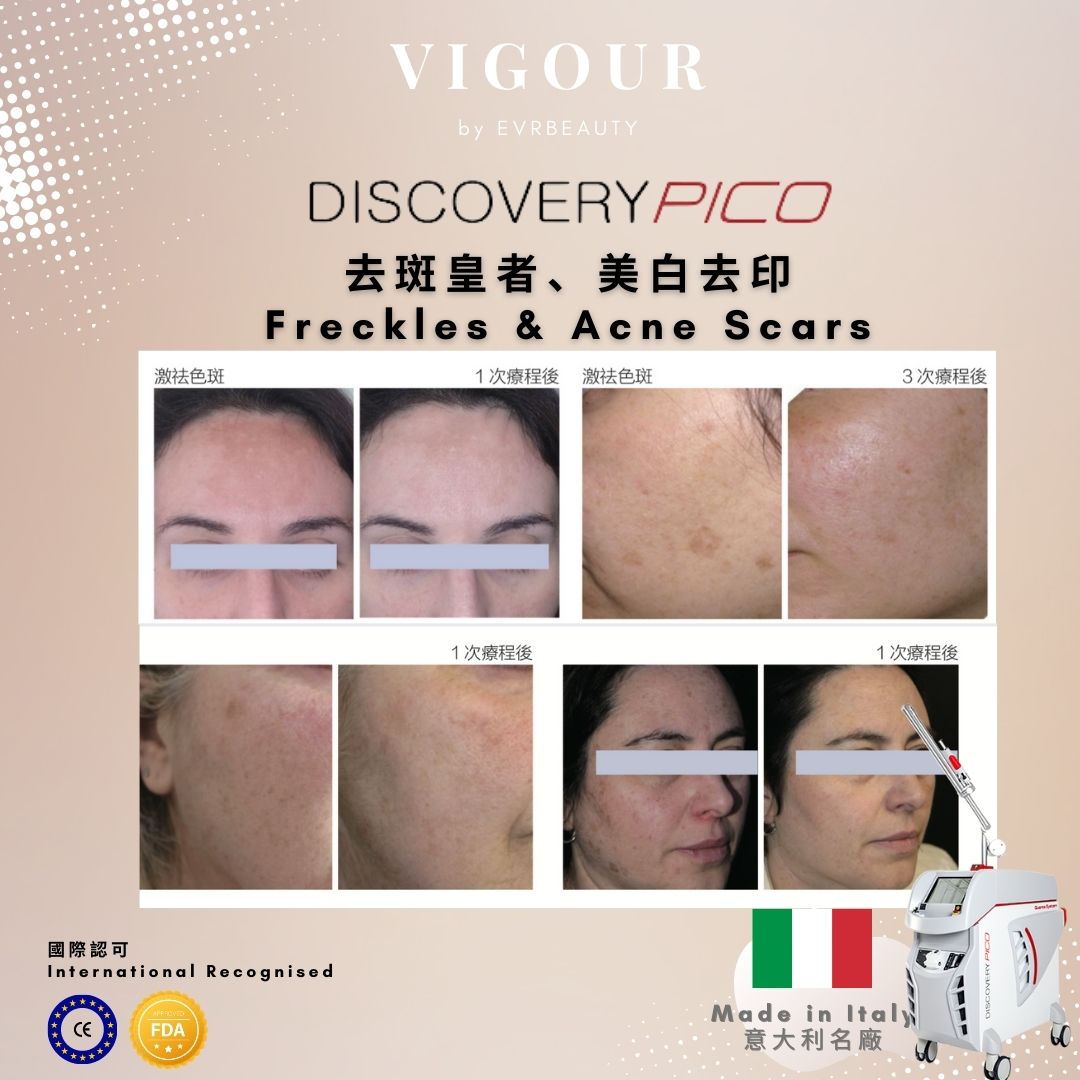 【Whitening and speckle removal】Pico 1064nm picosecond whitening and speckle removal laser 6 times