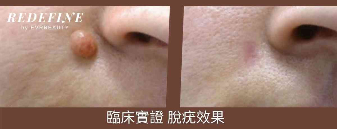 【New customers only】Laser wart removal treatment (CLAIM insurance available)